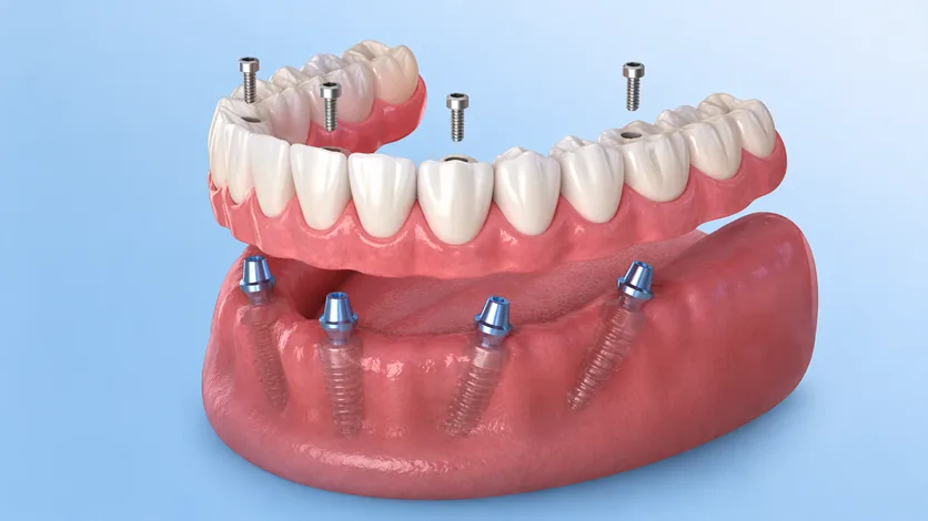 Emergency Dentist Houston | Implants, Dentures, Extractions — Dentistry clinic in Houston, TX — photo 6