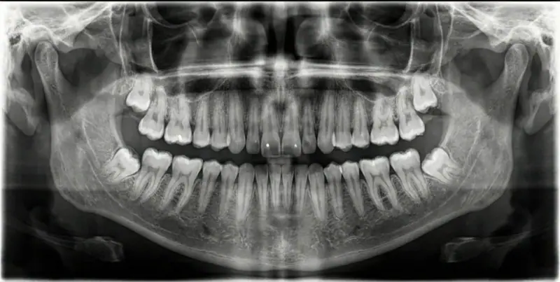 Phim X-quang toàn cảnh dùng để lên kế hoạch nhổ răng tại Texas Dental Center ở Houston