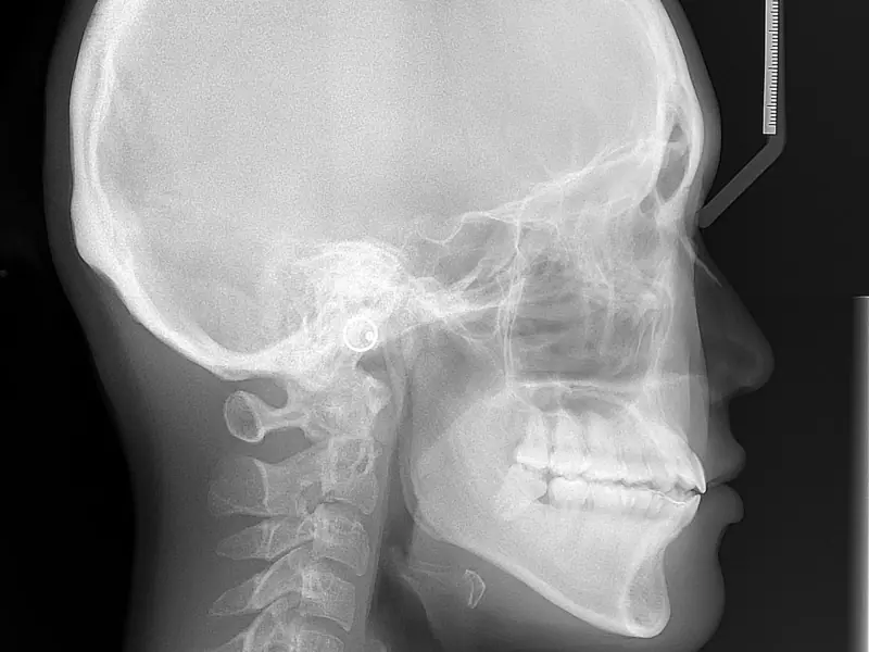 Lateral cephalometric X-ray showing the skull, jaws, teeth and facial profile, used to plan orthodontic treatment.